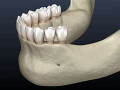 Image result for Jawbone Deterioration
