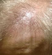 Image result for Small Bumps On Scalp