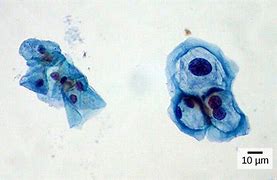 Image result for HPV Condyloma Acuminatum