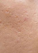 Image result for Acne Scars Cheeks