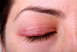 Image result for Inflamed Eyelid