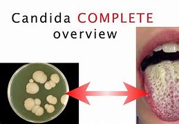 Image result for Candida Albicans Skin