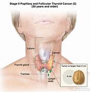 Image result for Thyroid Tumor