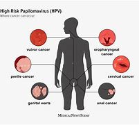 Image result for Human Papillomavirus Genital Lesions