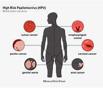 Image result for Human Papillomavirus Treatment for Men