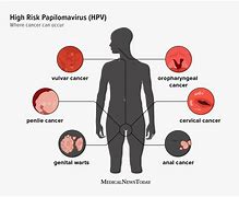 Image result for Human Papillomavirus Infection Tree Man