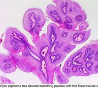 Image result for Fungiform Type of Sinonasal Papilloma