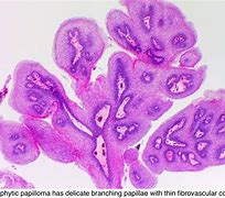 Image result for Carcinoma Ex Sinonasal Papilloma