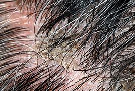 Image result for Scalp Warts