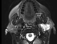 Image result for Deep Lobe Parotid Tumor