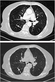 Image result for What Is a Lung Nodule