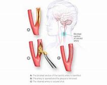 Image result for Carotid Artery Plaque Removal