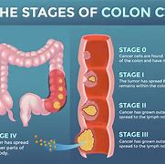 Image result for Stages of Colon Cancer Symptoms