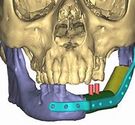 Image result for Jaw Cancer Surgery