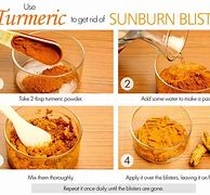 Image result for SunBurn Blister Treatment
