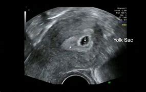 Image result for Pregnancy Ultrasound at 5 Weeks