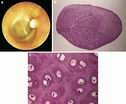 Image result for choristoma