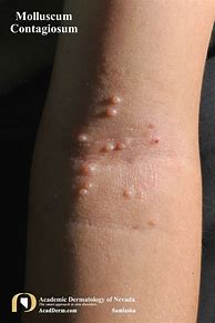 Image result for Molluscum Contagiosum in Adults Legs