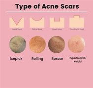 Image result for Different Acne Scars