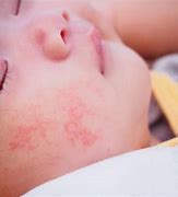 Image result for Allergic Reaction Rash On Baby