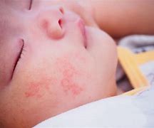 Image result for Allergie Baby Ausschlag