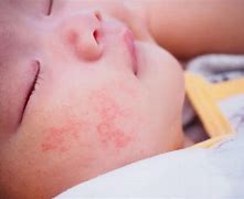 Image result for Skin Allergic Reaction