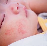 Image result for Baby Food Allergy Rash
