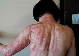 Image result for Napalm Girl burn treatment