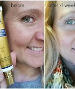 Image result for Wart Removal Cream Before and After