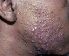 Image result for Acne Black Skin