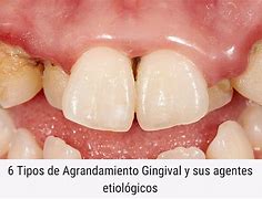 Image result for agrandamiento