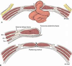 Image result for abdomjnal