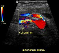 Image result for Renal Artery Bruit
