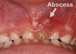 Image result for Radicular Cyst vs Periapical Abscess