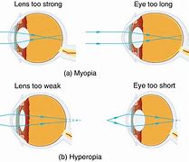 Image result for Myopia Concave Lens