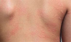 Image result for Dermatitis Torso