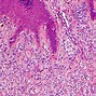 Image result for Ballooning Melanoma Histology