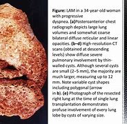 Image result for Lymphangioleiomyomatosis