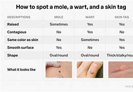 Image result for Skin Tags Under Arms