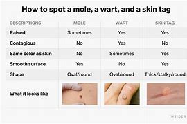 Image result for HPV Under Tongue Skin Tags