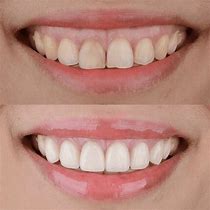 Image result for How to Fix a Wide Smile
