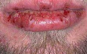 Image result for Chlamydia Skin Infection