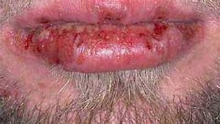 Image result for Chlamydia Rash On Body