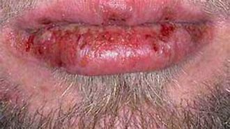 Image result for chlamydial on lip remedies