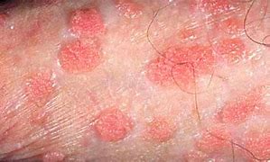 Image result for Genital Sores in Men