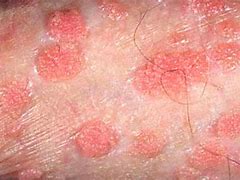Image result for Early Female Genital Warts