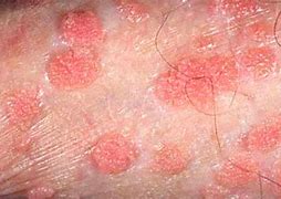 Image result for Male Genital Warts