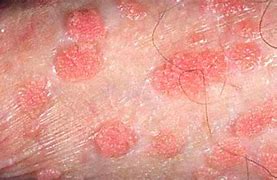 Image result for Genital Warts Red