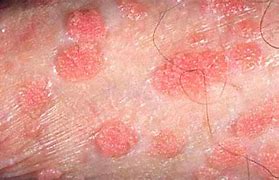 Image result for Signs You Have Genital Warts