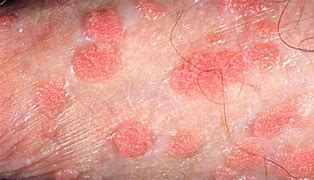 Image result for Human Papillomaviru Genital Warts